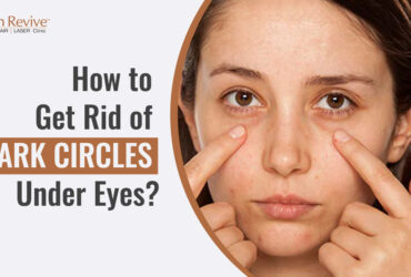 How to Get Rid of Dark Circles Under Eyes?