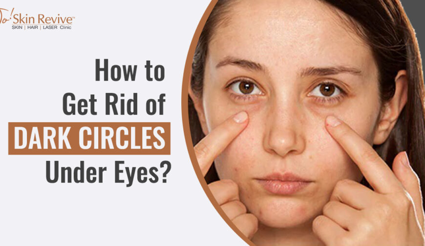 How to Get Rid of Dark Circles Under Eyes?
