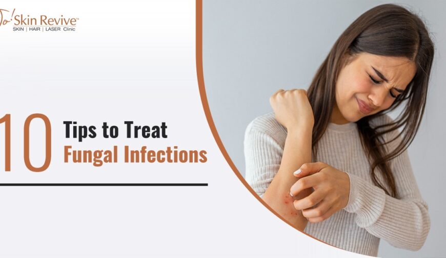 10 Tips to Treat Fungal Infections